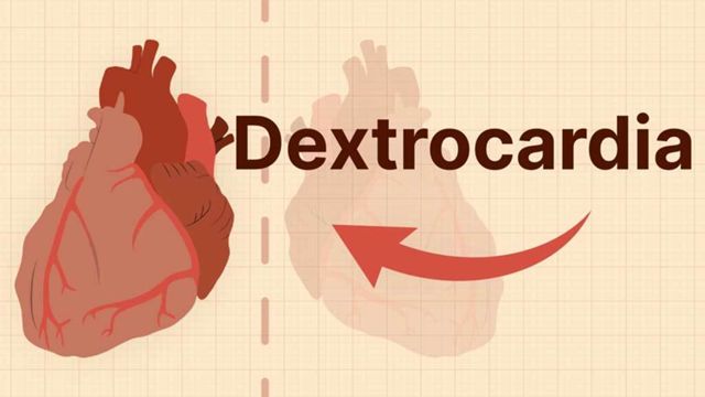Cover image for: Dextrocardia