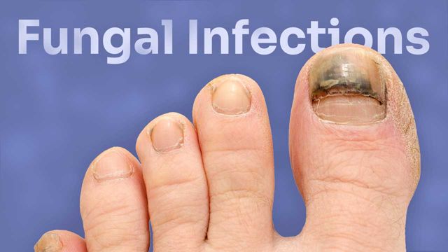 Image for Mycosis: Fungal Skin Infections