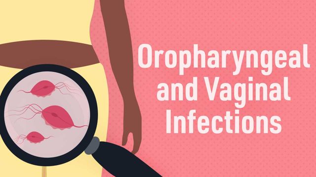 Image for Oropharyngeal and Vaginal Infections