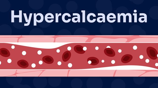 Image for Hypercalcaemia: An Oncological Emergency