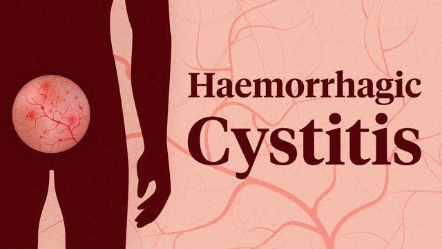 Cover image for: Haemorrhagic Cystitis