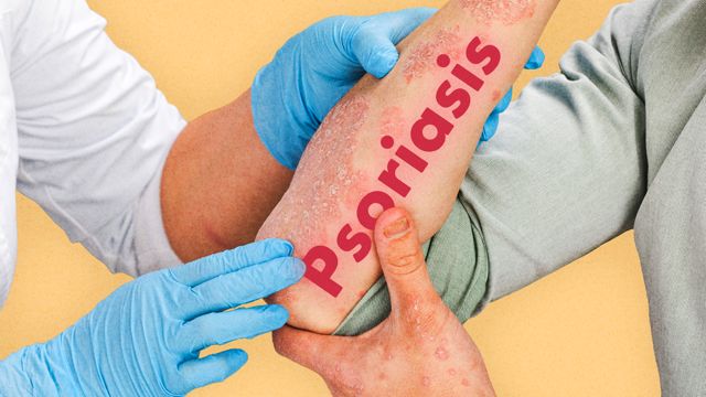 Cover image for: Psoriasis