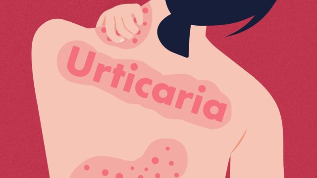 Image for Urticaria (Hives)