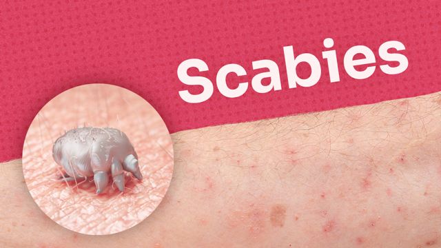 Image for Scabies in Residential Aged Care Facilities