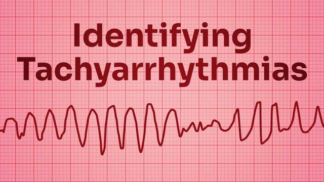 Image for Identifying Tachyarrhythmias 