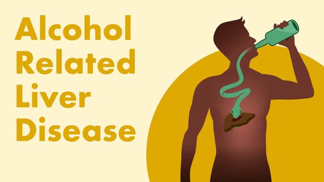 Image for Alcohol-Related Liver Disease